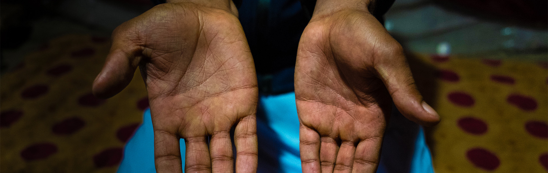 Mani bruciate e curate all'interno della nostra Clinica nel campo di Ashti