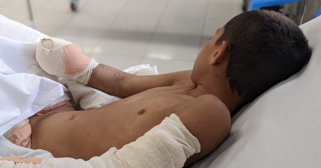 Vittime di mine: le storie dagli ospedali di EMERGENCY